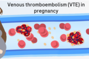 A pregnant woman with blood vessels that associated with risk of VTE in pregnancy (venous thromboembolism)