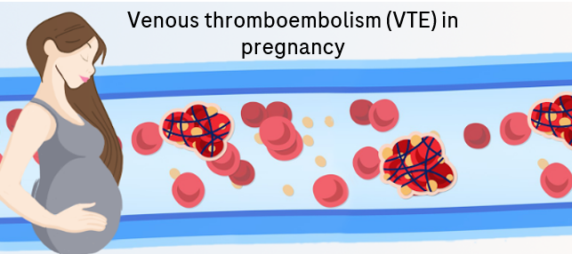 VTE in pregnancy (