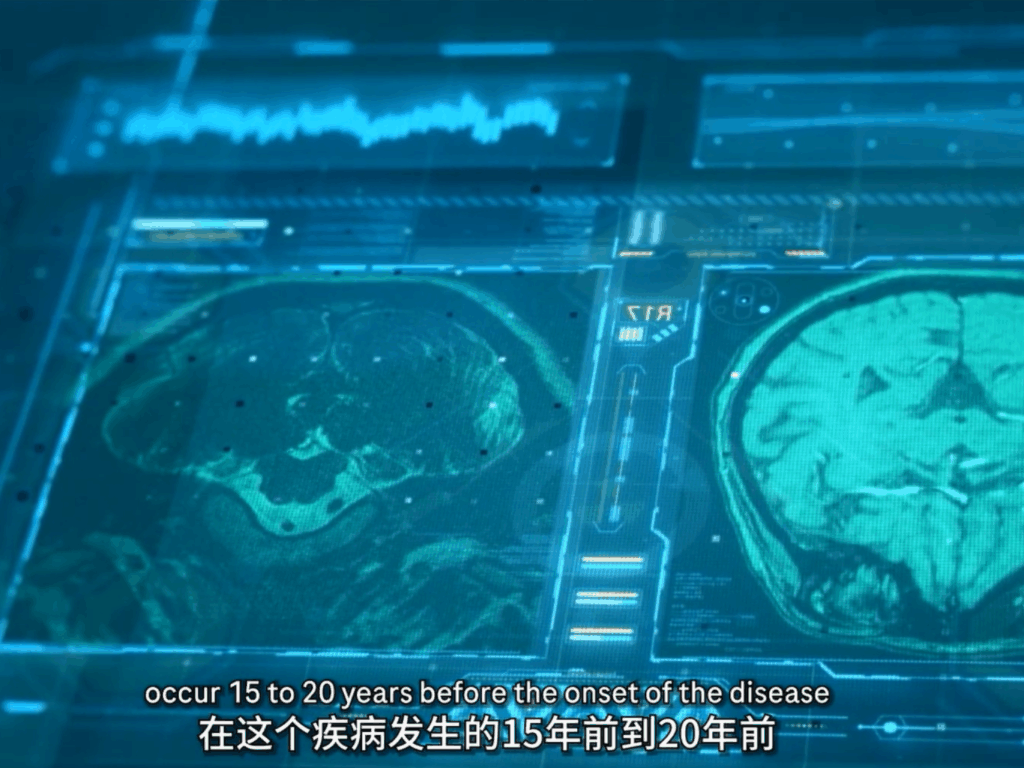 Alzheimer’s disease in China