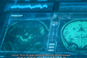 Alzheimer’s disease in China