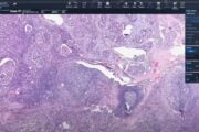 For breast cancer analysis, digital pathology offers a streamlined approach