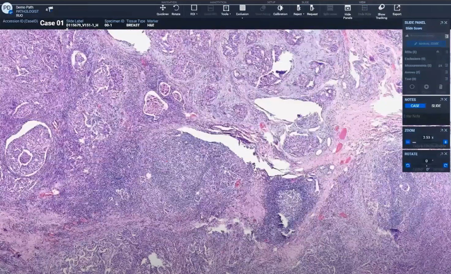 For breast cancer analysis, digital pathology offers a streamlined approach