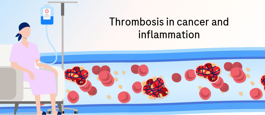 Thrombosis in cancer and inflammation: insights from Prof Ng Heng Joo